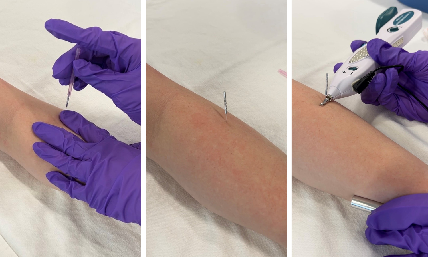 Dry Needling vs. Acupuncture